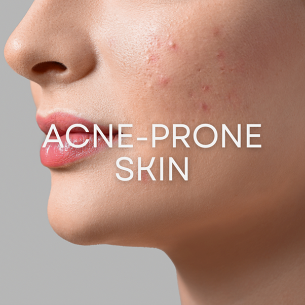 Acne Prone Skin