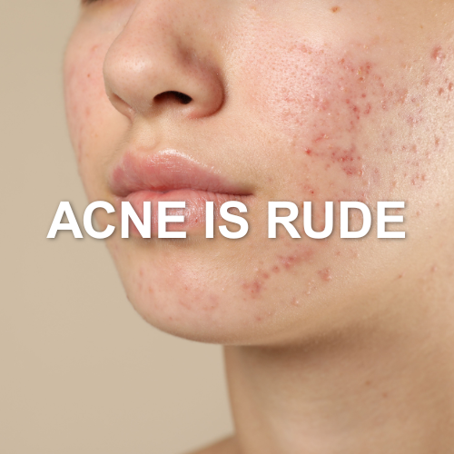 dealing with acne